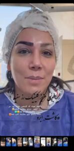 نمونه کاشت ابرو (دکتر محمود جعفری)