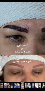 نمونه کاشت ابرو (دکتر محمود جعفری)
