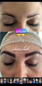 نمونه کاشت ابرو (دکتر محمود جعفری)