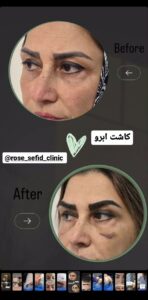 نمونه کاشت ابرو (دکتر محمود جعفری)