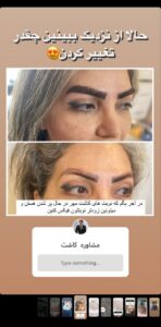 نمونه کاشت ابرو (دکتر محمود جعفری)