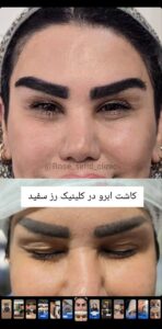 نمونه کاشت ابرو (دکتر محمود جعفری)
