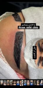 نمونه کاشت ابرو (دکتر محمود جعفری)