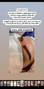 نمونه کاشت ابرو (دکتر محمود جعفری)