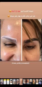 نمونه کاشت ابرو (دکتر محمود جعفری)