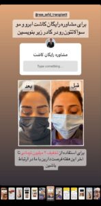 نمونه کاشت ابرو (دکتر محمود جعفری)