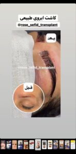نمونه کاشت ابرو (دکتر محمود جعفری)
