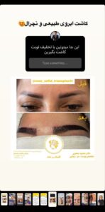 نمونه کاشت ابرو (دکتر محمود جعفری)