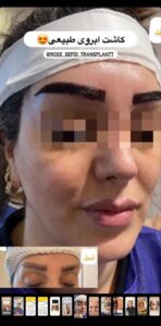 نمونه کاشت ابرو (دکتر محمود جعفری)