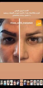 نمونه کاشت ابرو (دکتر محمود جعفری)