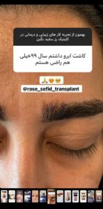 نظر کاشت ابرو (دکتر محمود جعفری)