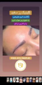 نمونه کاشت ابرو (دکتر محمود جعفری)