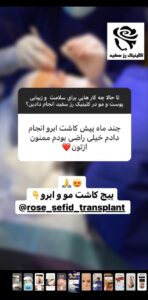 نظر کاشت ابرو (دکتر محمود جعفری)