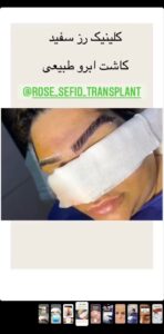 نمونه کاشت ابرو (دکتر محمود جعفری)