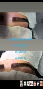 نمونه کاشت ابرو (دکتر محمود جعفری)