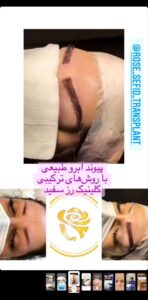 نمونه کاشت ابرو (دکتر محمود جعفری)
