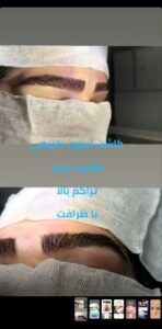 نمونه کاشت ابرو (دکتر محمود جعفری)