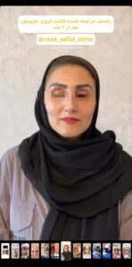 نظر کاشت ابرو (دکتر محمود جعفری)