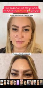 نظر کاشت ابرو (دکتر محمود جعفری)