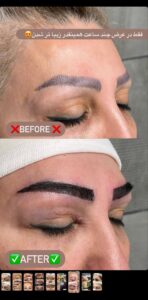 نمونه کاشت ابرو (دکتر قاسم رحمت پوررکنی)