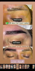 نمونه کاشت ابرو (دکتر قاسم رحمت پوررکنی)