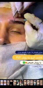 نمونه کاشت ابرو (دکتر قاسم رحمت پوررکنی)