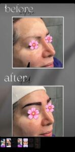 نمونه کاشت ابرو (دکتر قاسم رحمت پوررکنی)