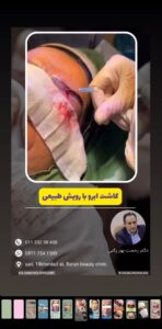 نمونه کاشت ابرو (دکتر قاسم رحمت پوررکنی)