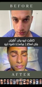 نمونه کاشت ابرو (دکتر قاسم رحمت پوررکنی)