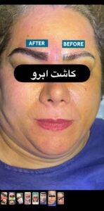 نمونه کاشت ابرو (دکتر قاسم رحمت پوررکنی)