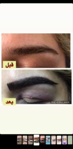 نمونه کاشت ابرو (دکتر قاسم رحمت پوررکنی)