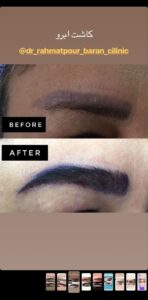 نمونه کاشت ابرو (دکتر قاسم رحمت پوررکنی)