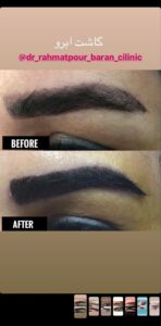 نمونه کاشت ابرو (دکتر قاسم رحمت پوررکنی)