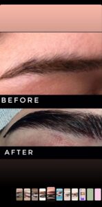 نمونه کاشت ابرو (دکتر قاسم رحمت پوررکنی)