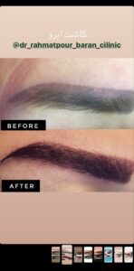 نمونه کاشت ابرو (دکتر قاسم رحمت پوررکنی)