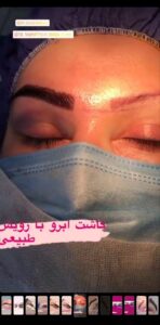 نمونه کاشت ابرو (دکتر قاسم رحمت پوررکنی)