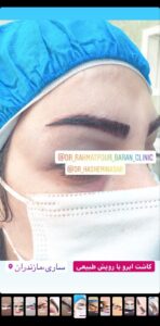 نمونه کاشت ابرو (دکتر قاسم رحمت پوررکنی)