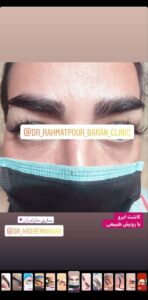 نمونه کاشت ابرو (دکتر قاسم رحمت پوررکنی)