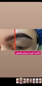 نمونه کاشت ابرو (دکتر قاسم رحمت پوررکنی)