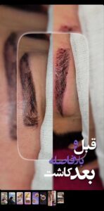 نمونه کاشت مو (كلينيك كاشت مو و ابرو پديده)