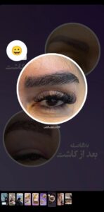 نمونه کاشت مو (كلينيك كاشت مو و ابرو پديده)