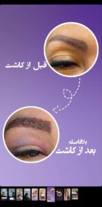 نمونه کاشت مو (كلينيك كاشت مو و ابرو پديده)