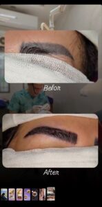 نمونه کاشت مو (كلينيك كاشت مو و ابرو پديده)