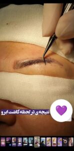 نمونه کاشت مو (كلينيك كاشت مو و ابرو پديده)