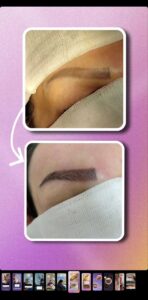 نمونه کاشت مو (كلينيك كاشت مو و ابرو پديده)