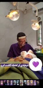 نمونه کاشت مو (كلينيك كاشت مو و ابرو پديده)