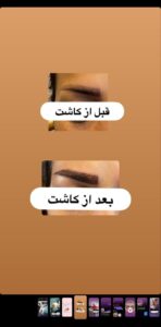 نمونه کاشت مو (كلينيك كاشت مو و ابرو پديده)