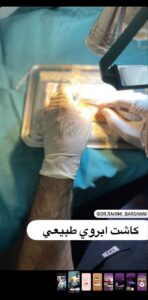 نمونه کاشت مو (كلينيك كاشت مو و ابرو پديده)