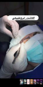 نمونه کاشت مو (كلينيك كاشت مو و ابرو پديده)