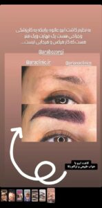 نمونه کاشت مو (كلينيك كاشت مو آرا)